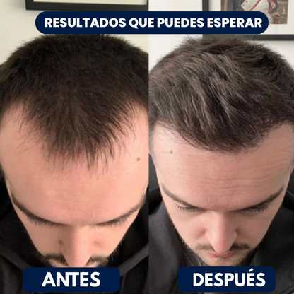 Revihair™: El sérum que está frenando la caída del cabello.