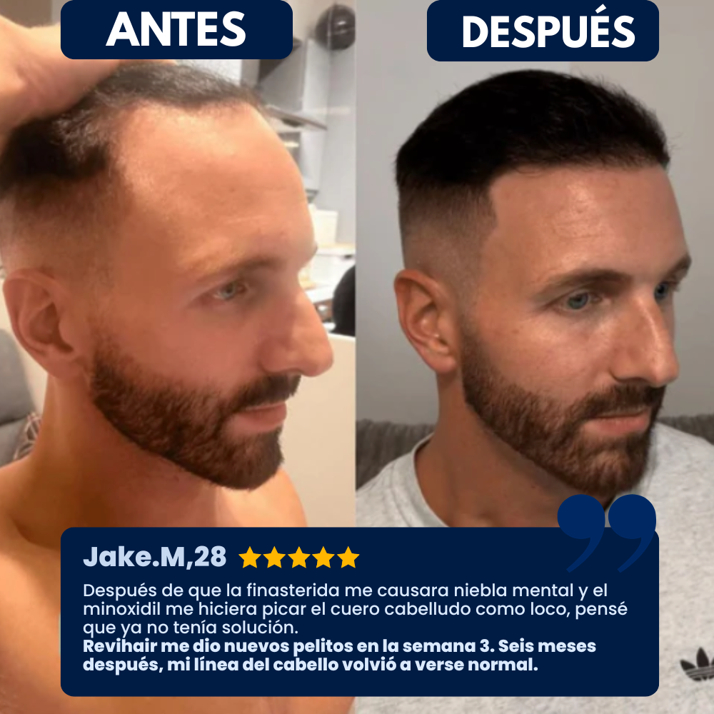 Revihair™: El sérum que está frenando la caída del cabello.