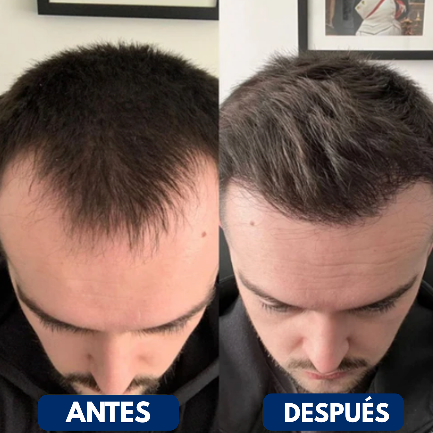 Revihair™ Roll-on de regeneración capilar